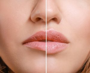 Hyaloron-Lippenvergrößerung